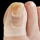 巻き爪ゲルサポーター